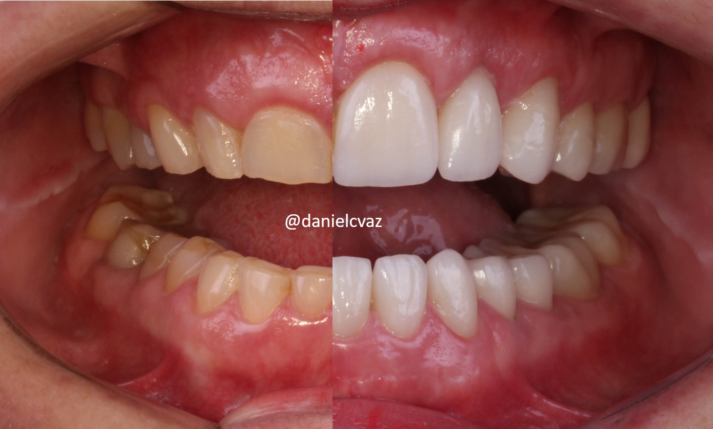 Antes e depois tratamento estético dental