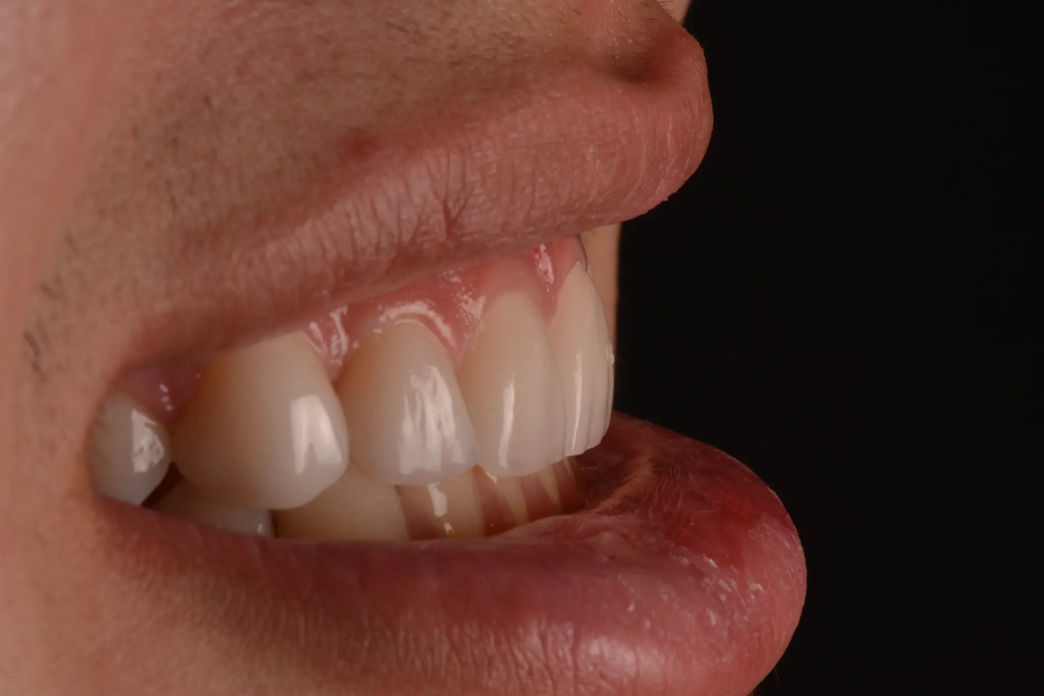 Detalhe sorriso após tratamento estético